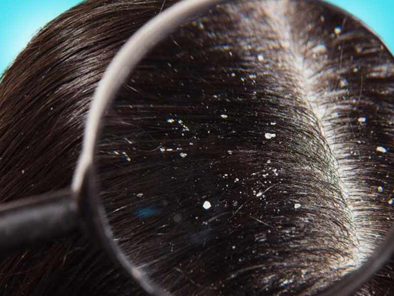 Tea Tree Oil reduces dandruff