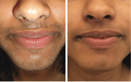 Laser facial hair removal