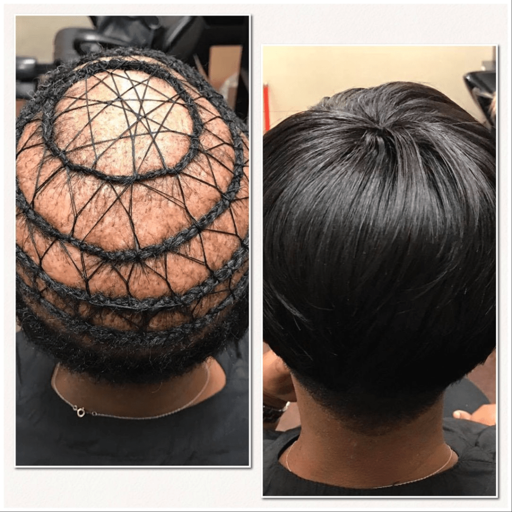 Hairstyle solutions for alopecia