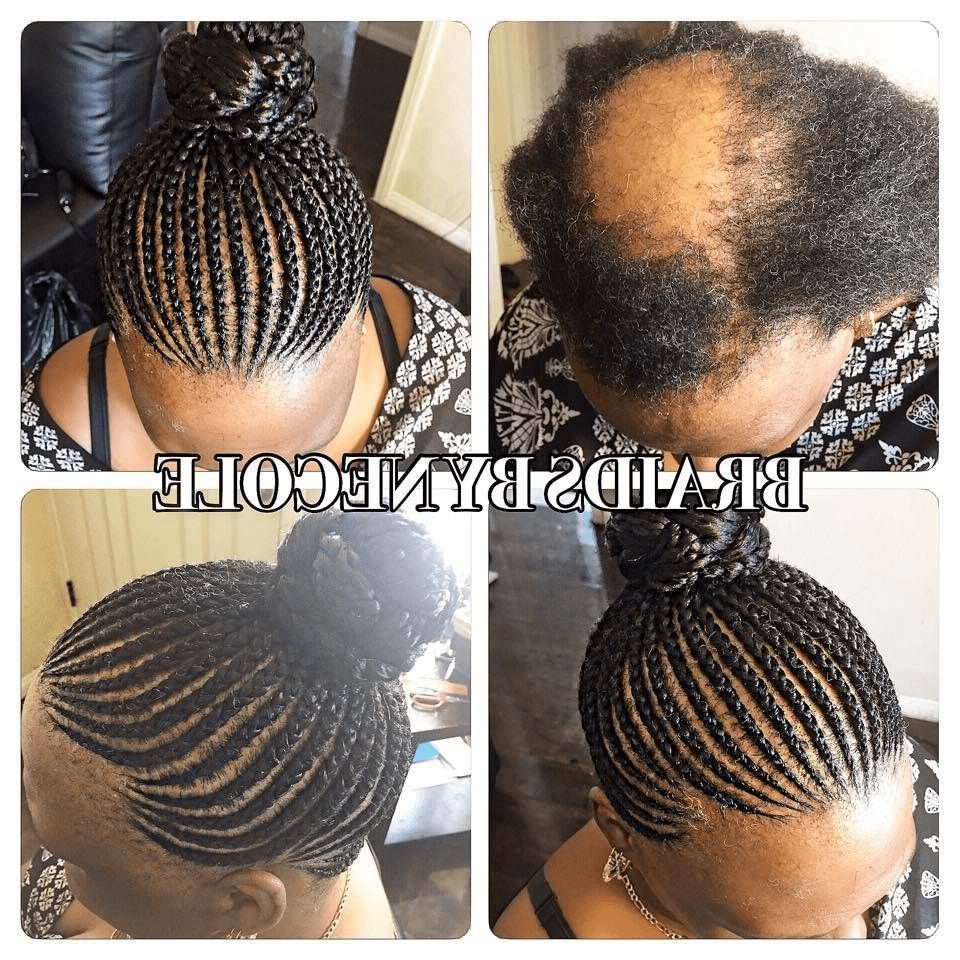 Braiding hair with alopecia